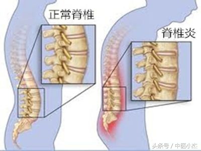 高考体检有强直性脊柱炎,孩子高考腰疼如何治疗