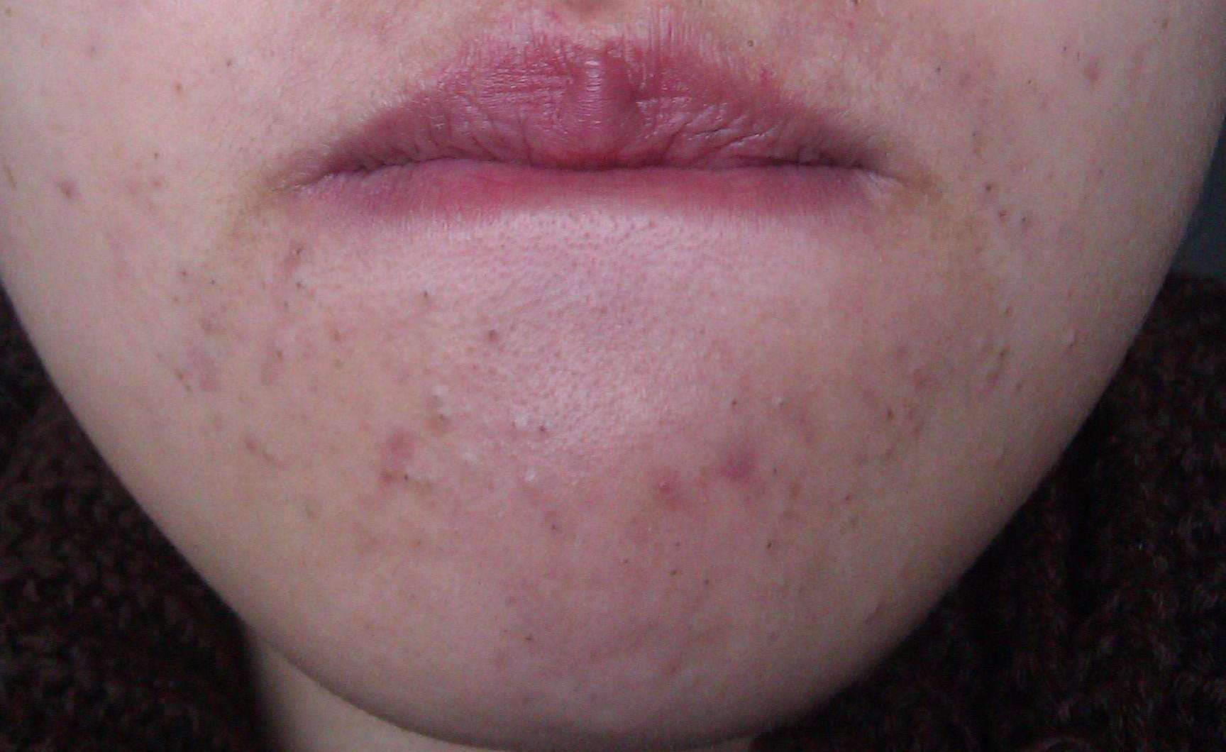 下巴有肉刺是什么病,下巴下面长很多小白点像白粉刺