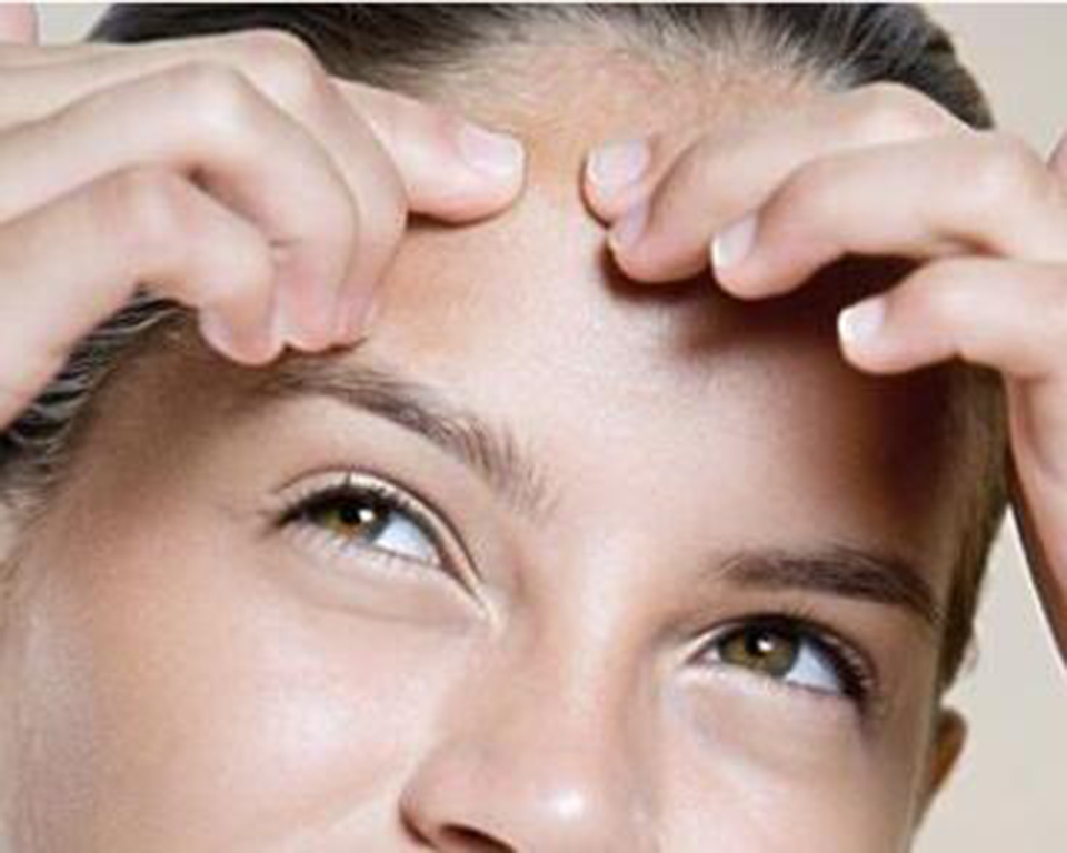 发际线长痘痘是什么原因，如何祛痘