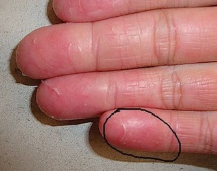 儿童热天手上有水泡是怎么回事,一到热天指尖就起小水泡怎么办