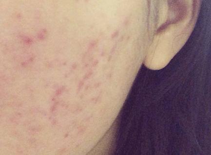 红色痘印怎么去除男士,红色痘印要怎么去除