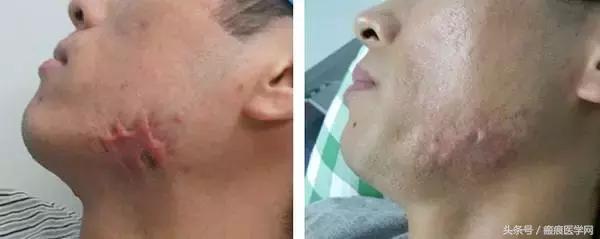 浅层放射治疗疤痕疙瘩,浅层x射线治疗疤痕疙瘩费用