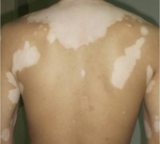 治疗白癜风最好的12副药,白癜风老中医快速治疗对话