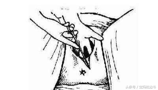 为什么医生不建议剖腹产顺产,宁可剖腹产也不用产钳