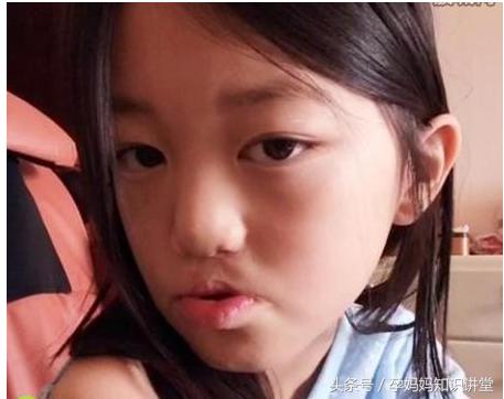 怀孕期间怎么防止胎儿兔唇,孕妇怎么避免胎儿兔唇