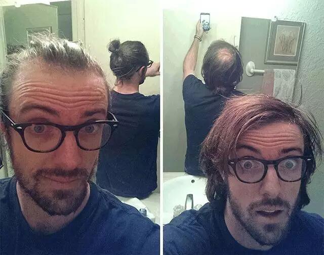 彻底摆脱脱发现在有什么技术,如何治愈脱发重新生发