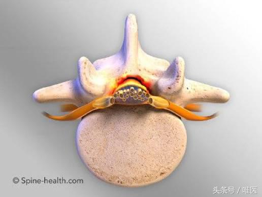 不小心把腰扭了怎么快速修复,不小心把腰扭了不太严重怎么处理