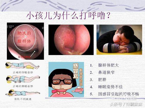 腺样体肥大可以吃中药调理缩小吗,儿童腺样体肥大吃什么中成药调理