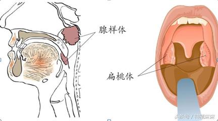 腺样体肥大可以吃中药调理缩小吗,儿童腺样体肥大吃什么中成药调理