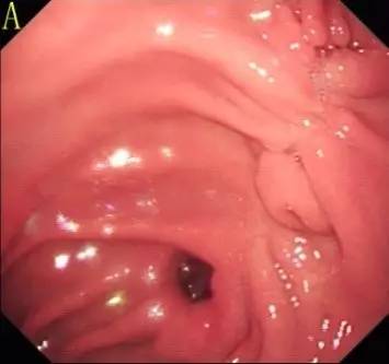 胃镜预处理流程,胃镜内镜手术全流程