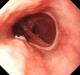 胃镜预处理流程,胃镜内镜手术全流程