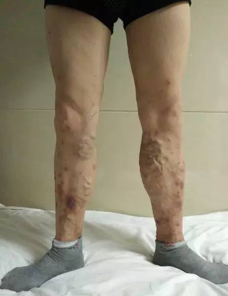 杏林中医院治静脉曲张吗,静脉曲张科普一下