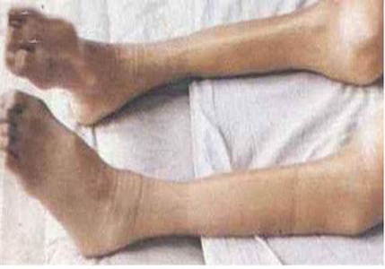 股骨头坏死导致肌肉萎缩能恢复吗,股骨头坏死肌肉萎缩还能恢复吗