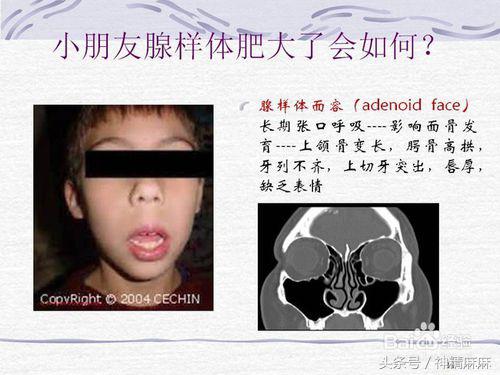 腺样体肥大可以吃中药调理缩小吗,儿童腺样体肥大吃什么中成药调理