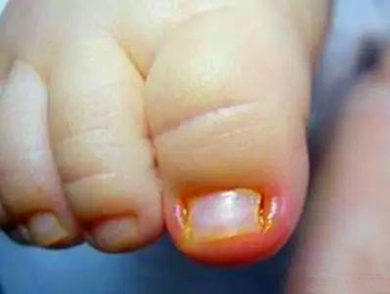 要怎么做才能让宝宝远离危险,宝宝为什么容易得甲沟炎