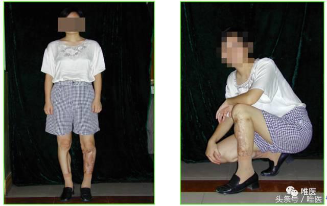 胫骨骨折骨缺损多大可以自愈,胫骨骨折有小块骨缺损影响吗