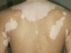 身上的白癜风白斑是怎么去治疗的,怎么检测身上的白斑是不是白癜风