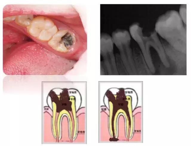 龋齿属于虫牙吗,蛀牙龋齿虫牙是怎么形成的