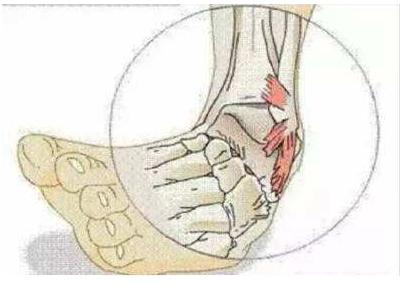 脚踝扭伤皮下有瘀血怎么处理,脚踝扭伤没有及时处理解决方法