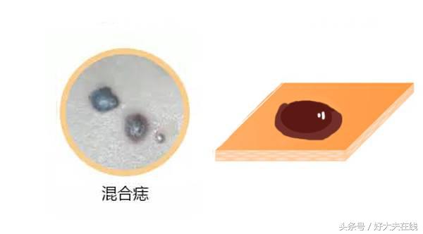 痣破损多久会有癌变的可能,浅表脂肪瘤样痣会癌变吗