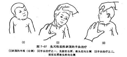 应该如何应对痉挛性斜颈儿童的抽动症跟这种病有什么关系