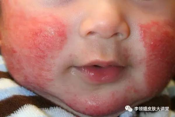 「杏林微科普」如何护理特应性皮炎患儿？