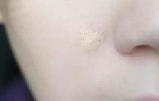 黑眼圈有痘痘怎么治,女人有黑眼圈