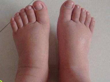 孕妈会出现尿频的症状,孕妈泌尿系统感染