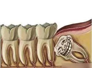 吃饭塞牙缝就牙疼吃什么药,牙缝大吃饭塞牙缝痛怎么办
