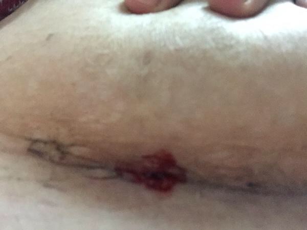 剖腹产伤口多长时间缝合线吸收,剖腹产伤口缝合线需不需要拆线