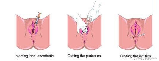 顺产和剖腹产对宝宝的区别,不管是顺产还是剖腹产一定要坚强