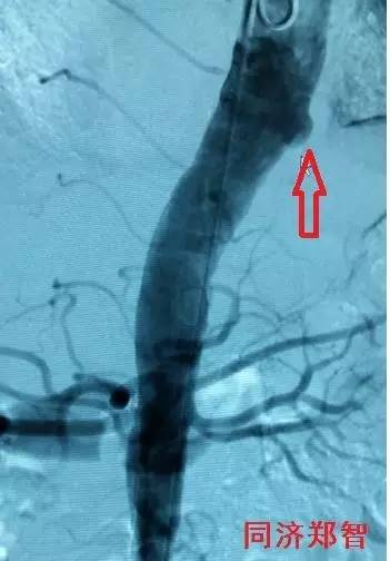 主动脉夹层差点要了老公的命,主动脉夹层兄妹