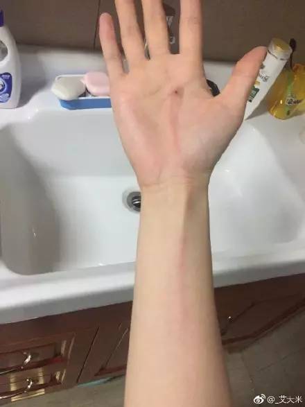 外国人被蚊子咬了后背长了个大包,被蚊子咬后留下硬疙瘩图片