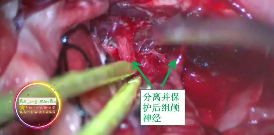 喝水容易呛是怎么回事是肺癌,老人喝水容易呛咳怎么办