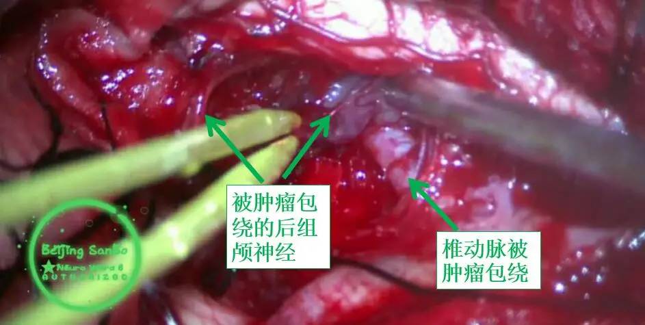 喝水容易呛是怎么回事是肺癌,老人喝水容易呛咳怎么办