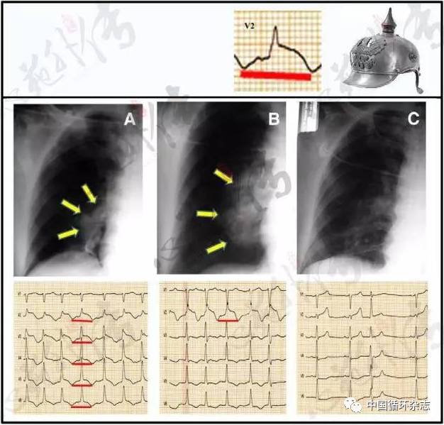 心电图军检常见问题,心电图标志