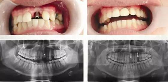 爱笑的人运气不会差牙齿黄,爱笑的人牙齿不好