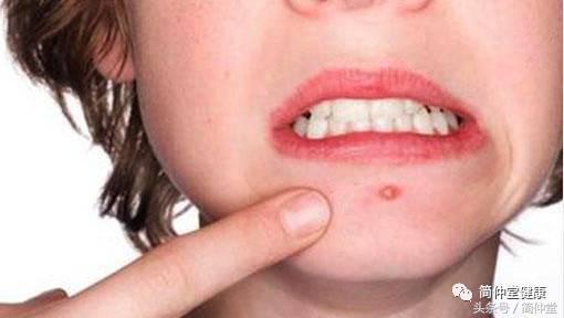 人中上长了个硬痘还疼,人中旁长痘预示着什么