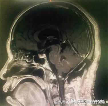 半年内多次脑出血心生绝望，学病友“跟风求医”