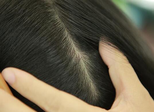 头皮上有一层厚厚的白色的头皮屑,头皮上有一层白色的头皮屑