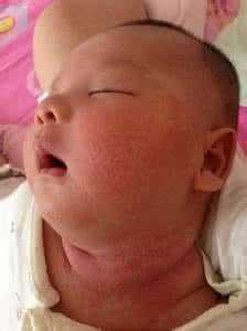 宝宝淹脖子的最佳治疗方法,宝宝淹脖子擦红霉素软膏还是眼膏