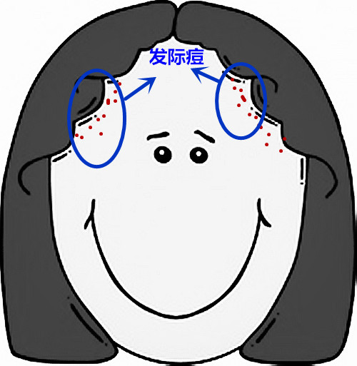 面部痘痘的症状图片和讲解,面部痘痘原因分析图片