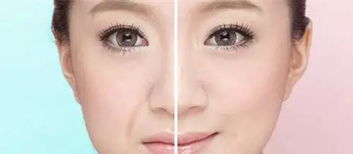 有了法令纹怎么消除,有了法令纹怎么消除的好方法