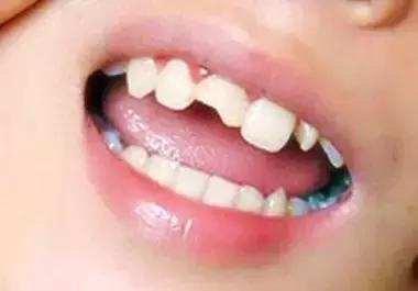 牙齿摔坏了可不是小事！处理不及时酿成苦果，国际牙外伤组织专家：这些错误一定要规避