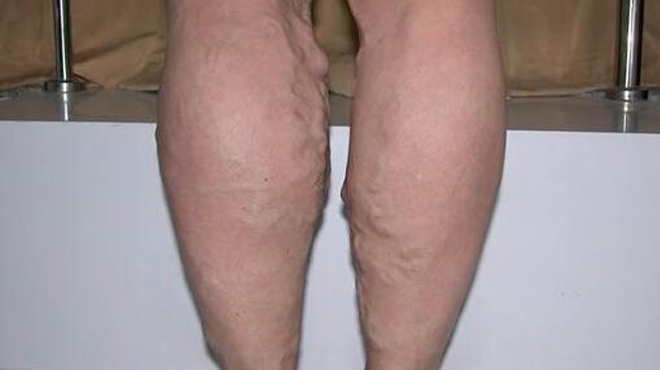 头上爆出青筋是什么原因,头上有青筋暴起怎么处理