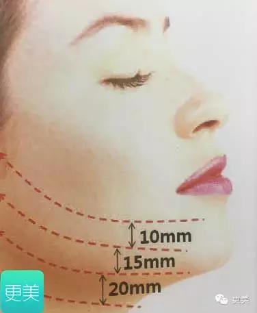 埋线美容线和不吸收线有什么区别,医院埋线和美容院埋线有什么差别