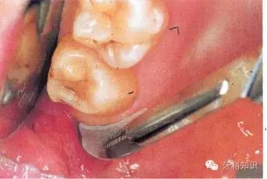 口腔拔牙图片,口腔拔牙麻醉多久消退