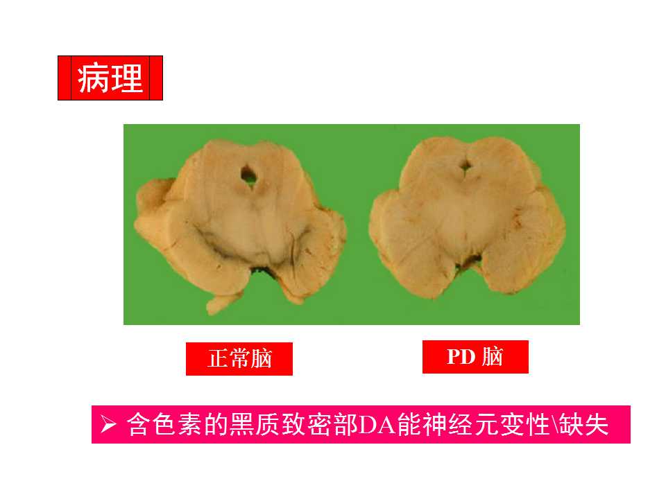多图详解帕金森及运动障碍性疾病|关于帕金森最全的一个课件