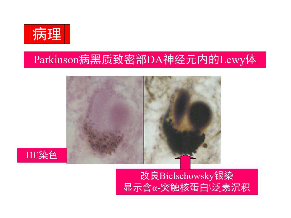 多图详解帕金森及运动障碍性疾病|关于帕金森最全的一个课件