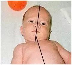 斜颈如何早发现,儿童斜颈怎么发现